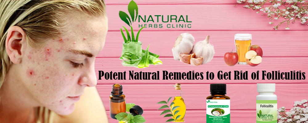 Natural Remedies for Folliculitis