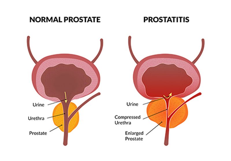 How does UTI or bacterial prostatitis cause proteinuria?