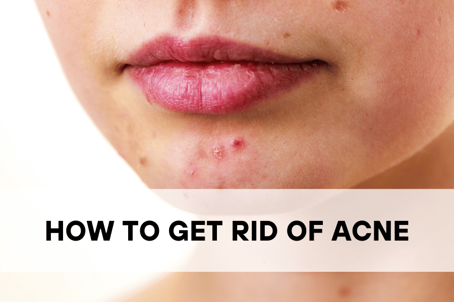 How to Get Rid of Acne — Keto by Joana Buymeacoffee
