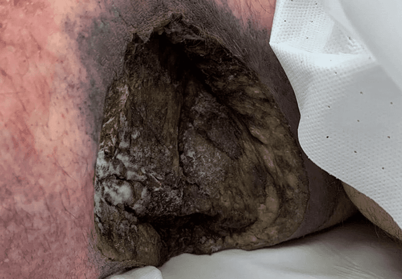Mucormycosis, a rare and rapidly progressing fungal infection