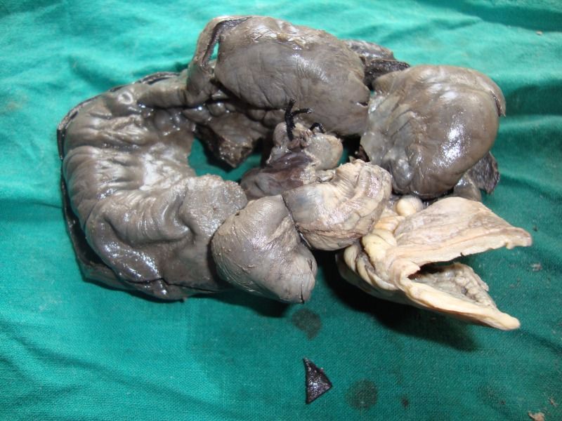 Small Intestinal Gangrene Complicating Term Pregnancy: A Case Report