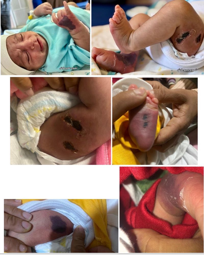 Help Baby Ghazal's Limbs and Life