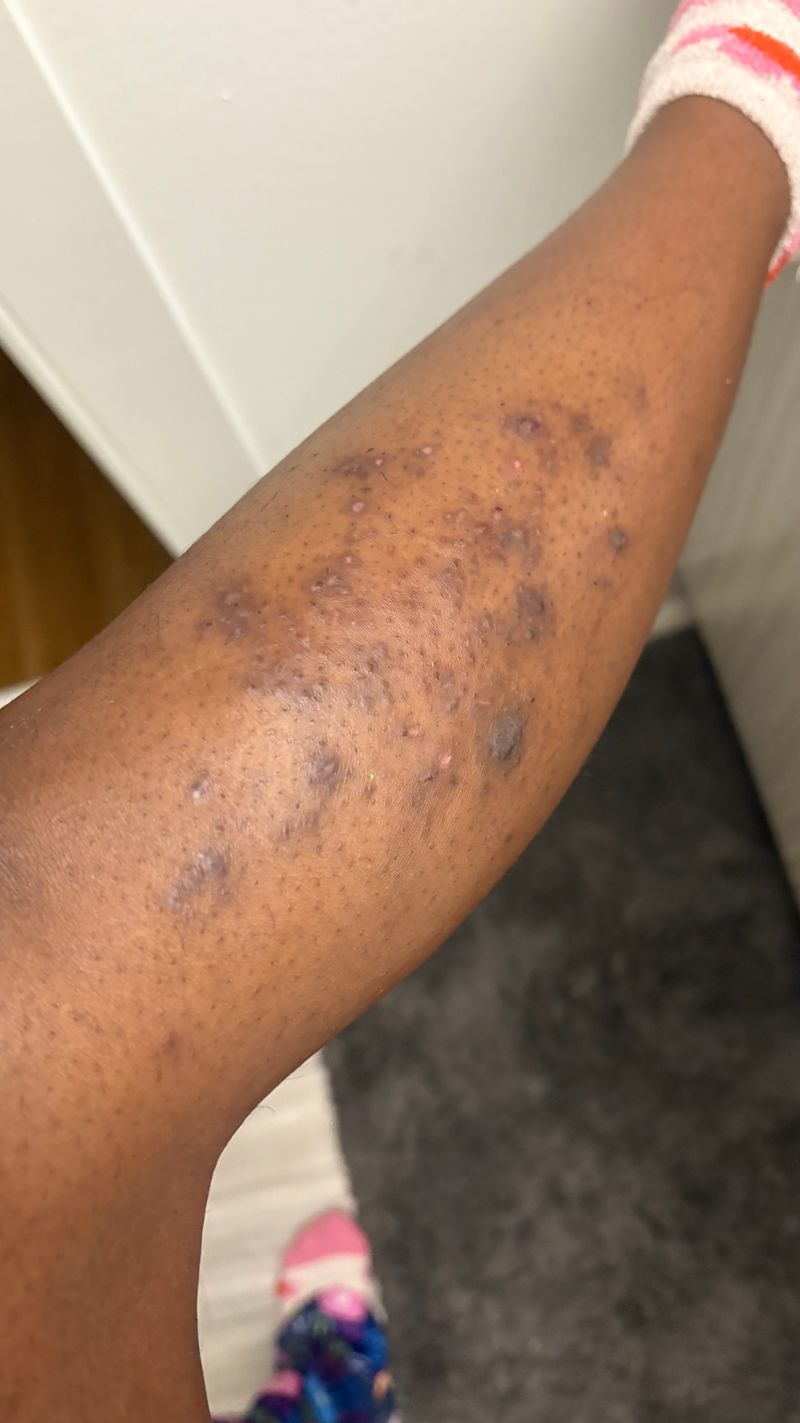 Post ingrown hair & KP hyperpigmentation treatment & prevention